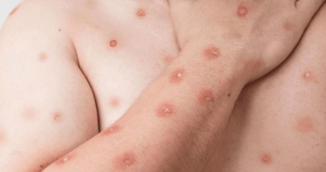 Casos de Mpox disparam no Rio e chegam a sete vezes o registrado no ano passado em apenas dois meses; capital enfrenta falta de vacinas contra a doença