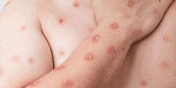 Casos de Mpox disparam no Rio e chegam a sete vezes o registrado no ano passado em apenas dois meses; capital enfrenta falta de vacinas contra a doença